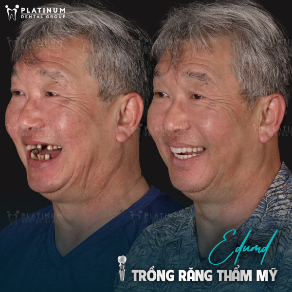 Tiêu xương nhiều có trồng Implant được không?