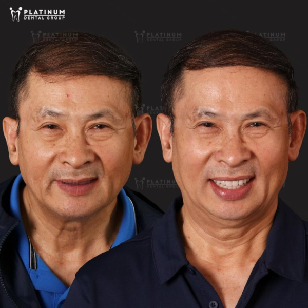 Mất răng lâu năm có trồng Implant được không?