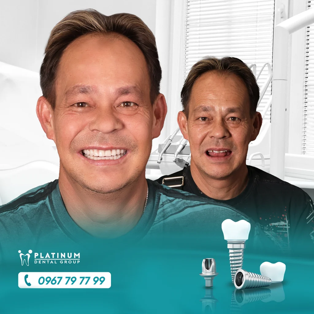 trong rang implant