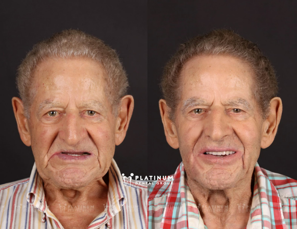 What is a zygoma implant? Advantages and disadvantages? Procedure? 3 Zygomatic bone grafting is often applied in complex cases such as patients who have lost all their teeth