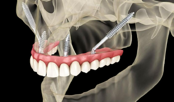 What is a zygoma implant? Advantages and disadvantages? Procedure? 1 Zygomatic Implant is an advanced restoration technique, specifically for patients who have lost teeth for many years with severe jaw bone loss