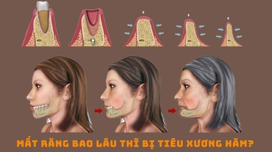 Mất răng lâu ngày, tiêu xương ổ răng - niềng răng bị hóp má