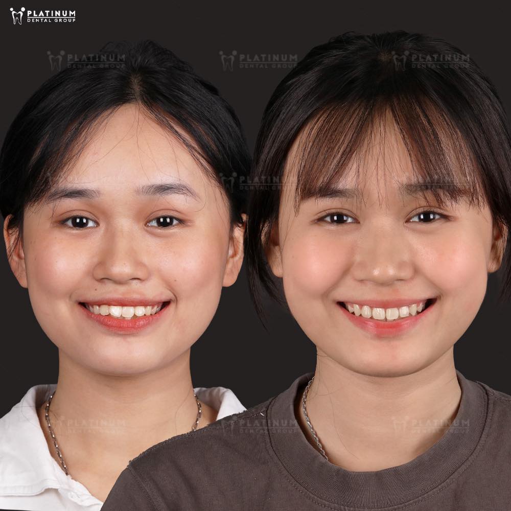 Niềng răng có bị hóp má không
