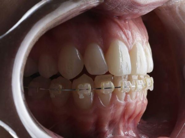 Chỉ niềng răng hàm dưới có được không? Thời gian niềng bao lâu? 1 Chỉ niềng hàm dưới khi hàm trên đã ổn định và khớp cắn chuẩn