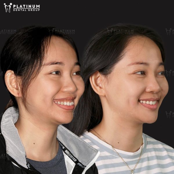 Chỉ niềng răng hàm dưới có được không? Thời gian niềng bao lâu? 4 Platinum Dental Group – Địa chỉ niềng răng hàm dưới uy tín với phác đồ điều trị cá nhân hóa