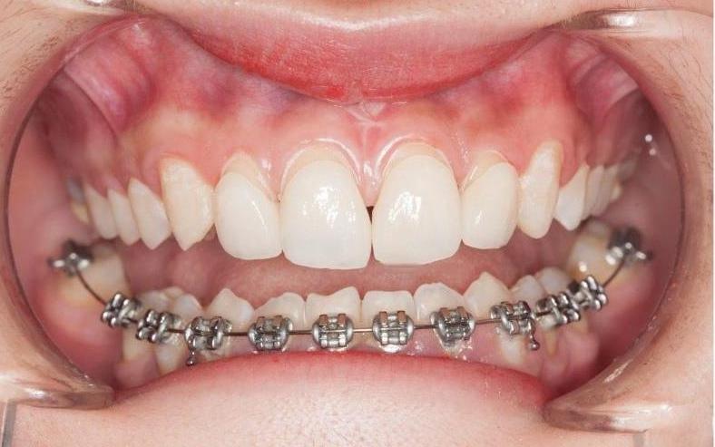 Sự khác nhau giữa niềng răng hàm dưới và niềng răng hàm trên