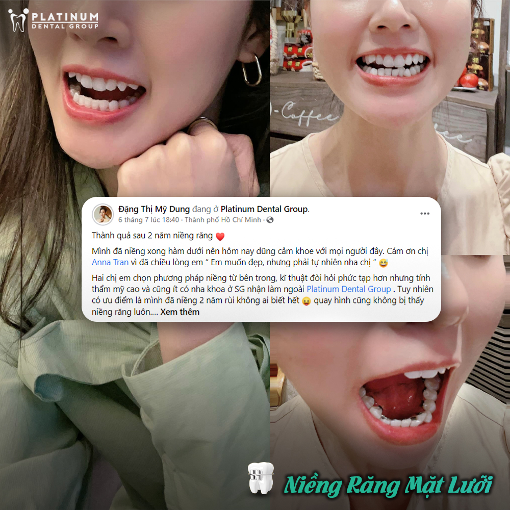 Thời gian niềng răng hàm dưới là bao lâu