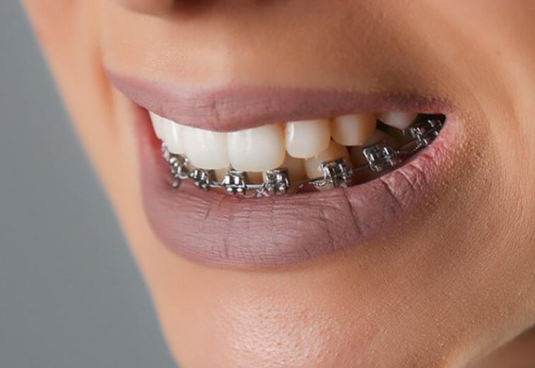 niềng răng hàm dưới có được không