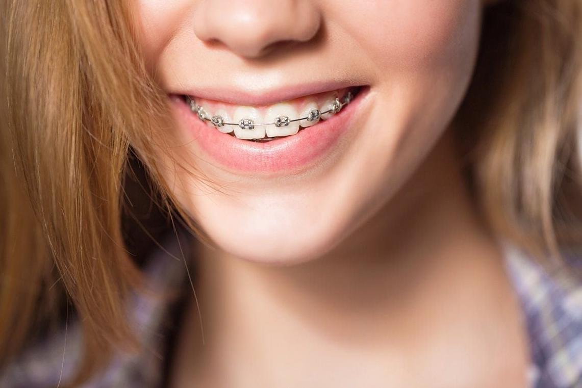 Niềng răng thưa có bị đau không
