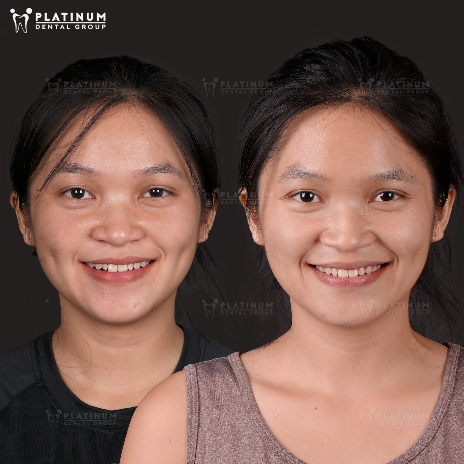 Răng thưa là gì