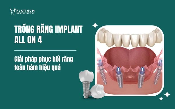 trồng răng implant all on 4