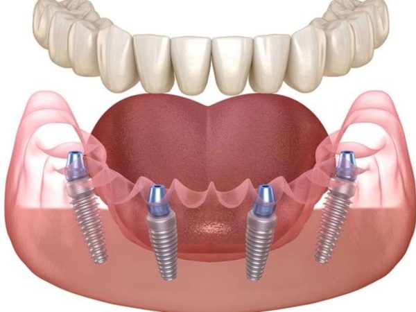 Trồng răng Implant All On 4 - Giải pháp phục hồi răng toàn hàm hiệu quả 1 Trồng răng Implant All On 4 sử dụng 4 trụ Implant để nâng đỡ và cố định toàn bộ dãy răng giả trên cùng một hàm
