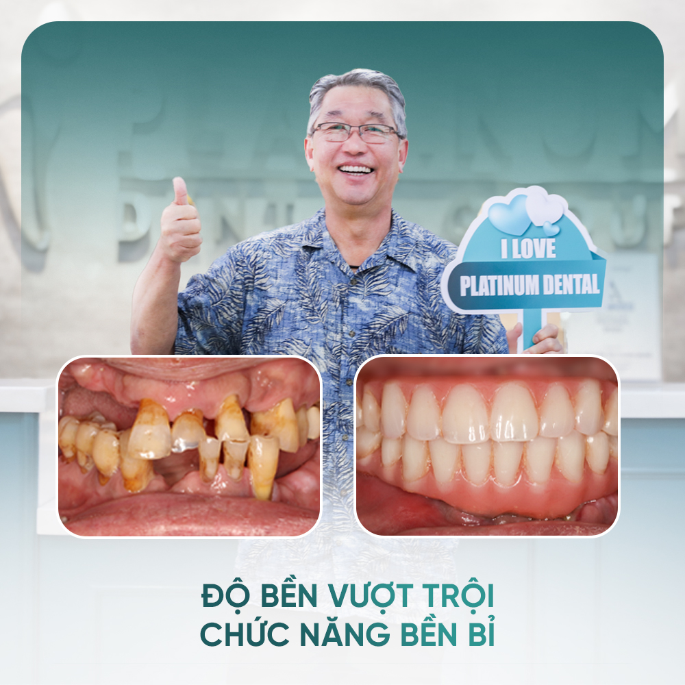 Đối tượng phù hợp thực hiện trồng răng Implant All on 4 
