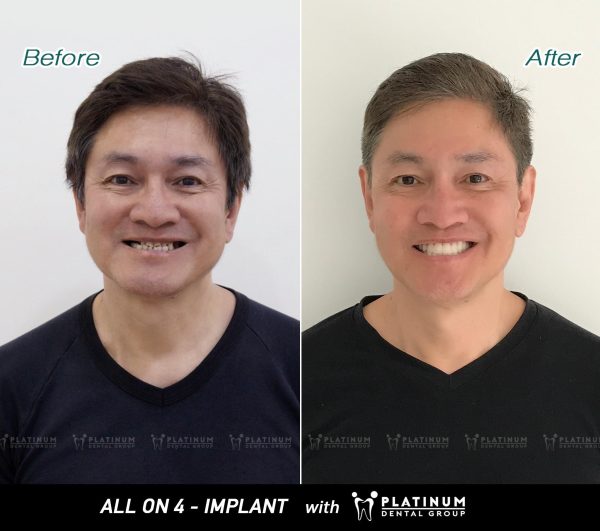 Trồng răng Implant All On 4 - Giải pháp phục hồi răng toàn hàm hiệu quả 7 Trồng răng Implant All On 4 mang đến nụ cười tự tin