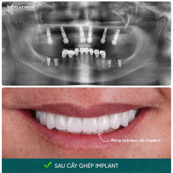 Trồng răng Implant All On 4 - Giải pháp phục hồi răng toàn hàm hiệu quả 6 Chỉ sau 2 - 3 giờ sau phẫu thuật đặt trụ, cô chú anh chị sẽ được gắn răng tạm cố định để đảm bảo tính thẩm mỹ và khả năng ăn nhai nhẹ