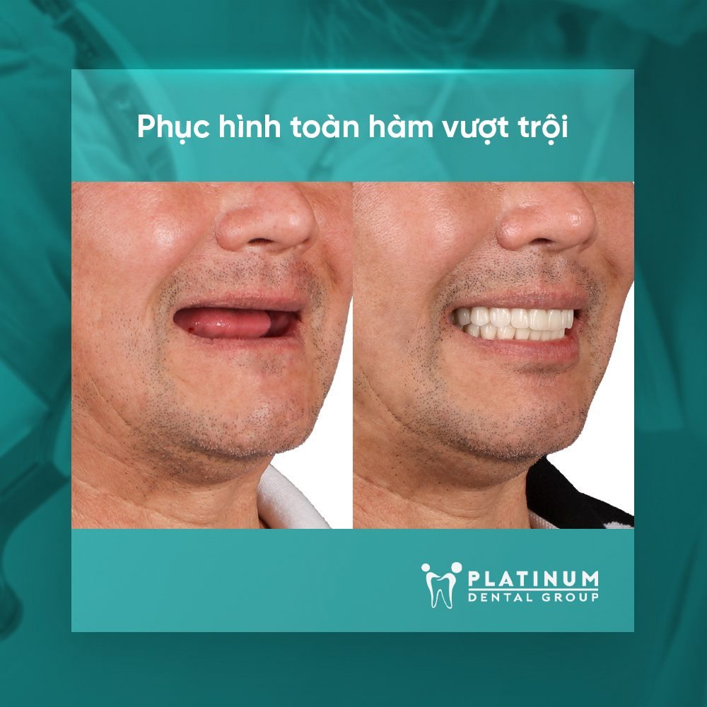 Lắp răng sứ cố định