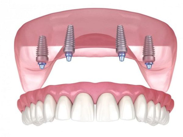 Trồng răng Implant All On 4 - Giải pháp phục hồi răng toàn hàm hiệu quả 3 Kỹ thuật All On 4 chỉ cần 4 trụ Implant cho mỗi hàm, ít can thiệp mô nướu hơn