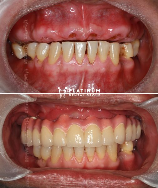 Trồng răng Implant All On 4 - Giải pháp phục hồi răng toàn hàm hiệu quả 8 Tình trạng xương hàm và mô nướu là yếu tố ảnh hưởng đến chi phí trồng răng Implant All On 4