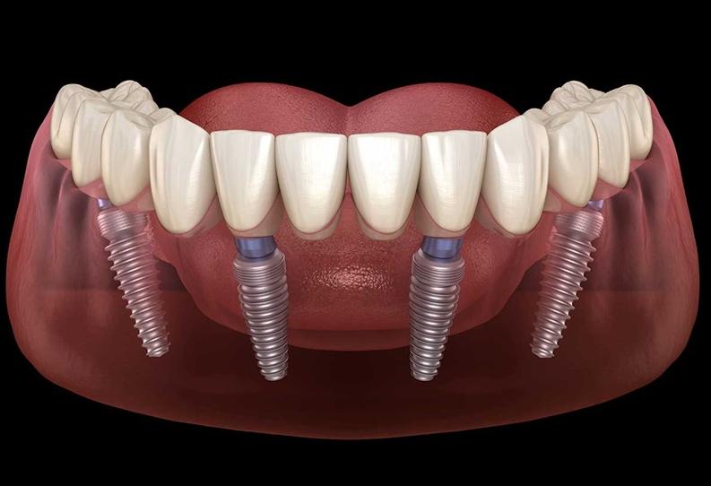 Trồng răng Implant All on 4 là gì
