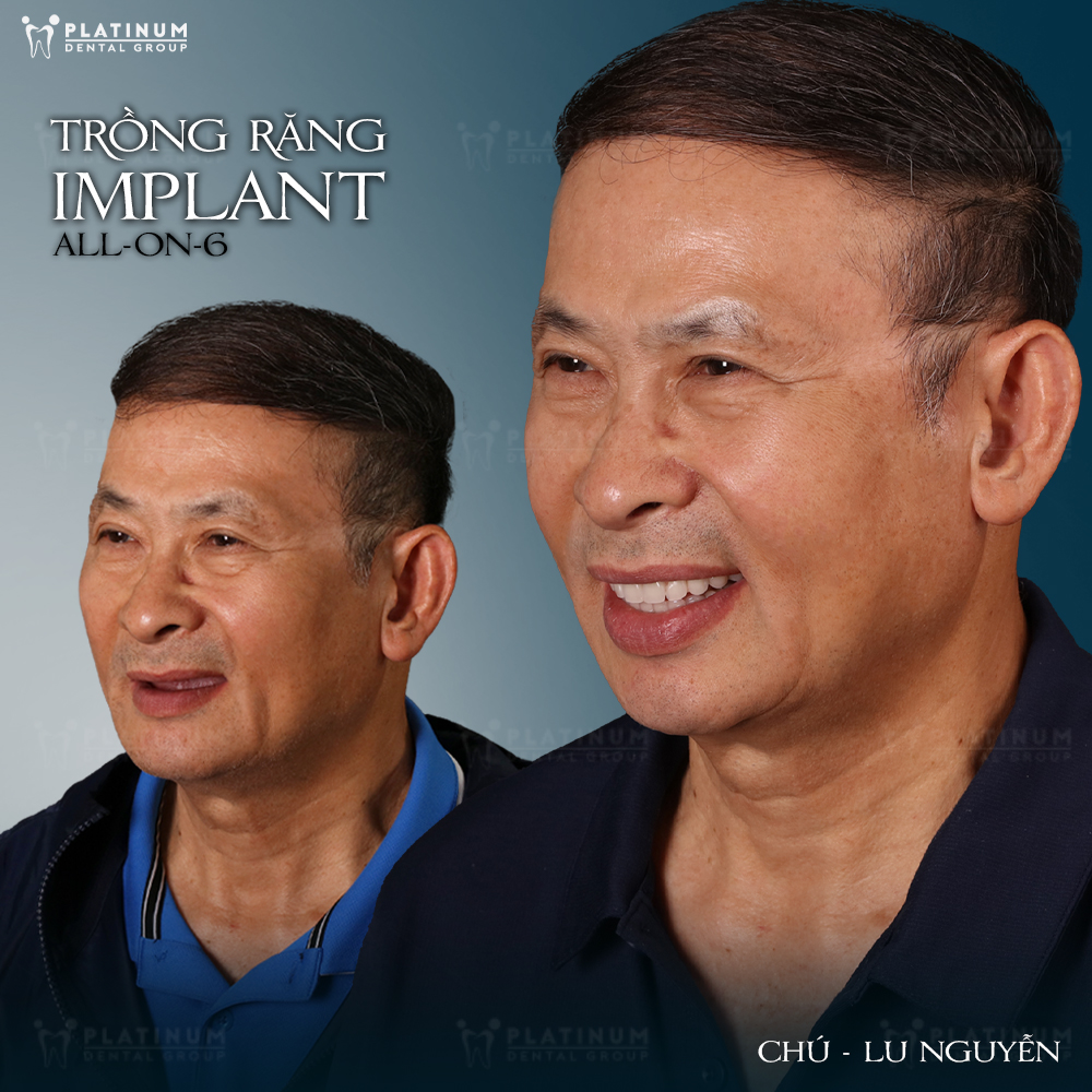 Trồng răng Implant all on 6 là gì