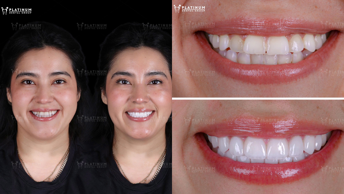 Smile transformation with porcelain Veneers at Platinum Dental Group – natural, harmonious results.