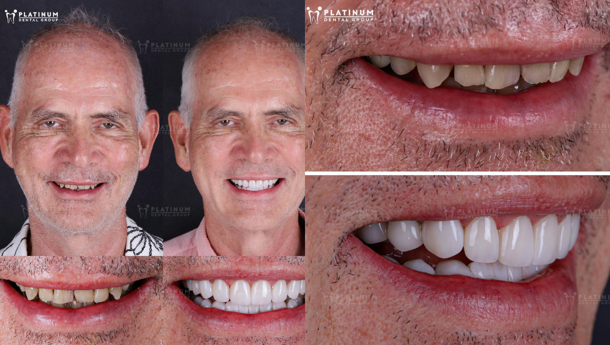 Restore teeth shape and color with custom porcelain Veneers at Platinum Dental Group for a confident smile.