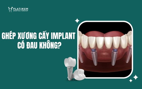 Ghép xương cấy Implant có đau không? Giải đáp chi tiết từ chuyên gia Platinum Dental Group
