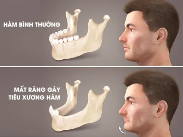 Tiêu xương hàm là gì?