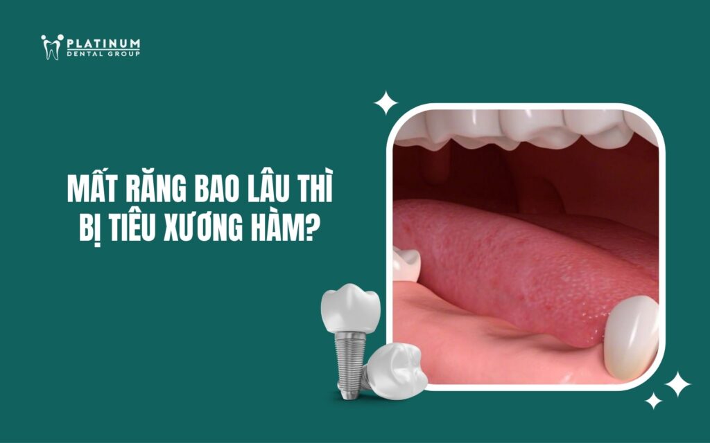 Mất răng bao lâu thì bị tiêu xương hàm? Nguyên nhân, hậu quả và cách khắc phục