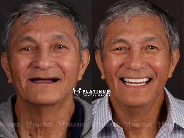 Dental implants help completely restore chewing ability