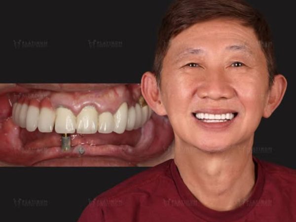 Implants provide a natural look, enhancing confidence and aesthetics