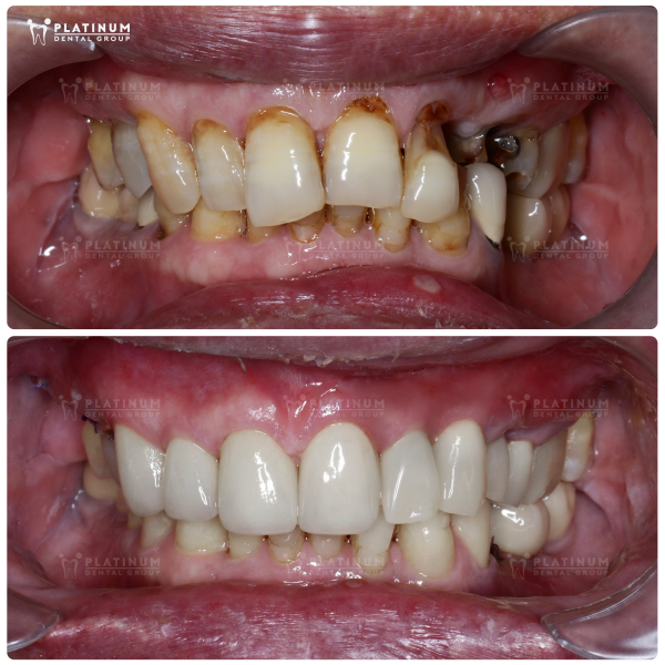 Not only protecting oral health, dental implants also bring lasting aesthetic beauty