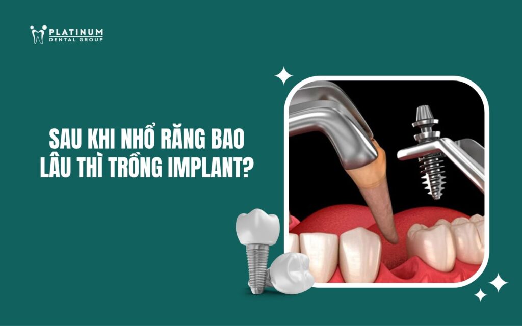 Sau khi nhổ răng bao lâu thì trồng Implant? Giải đáp từ bác sĩ