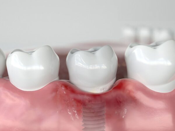 Tác hại của việc trồng răng Implant: Những biến chứng cần biết và cách phòng tránh 1 Nhiễm trùng là biến chứng phổ biến nhất khi cấy ghép Implant