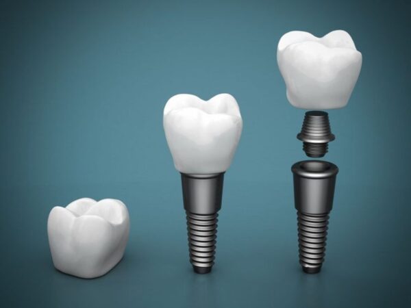 Tác hại của việc trồng răng Implant: Những biến chứng cần biết và cách phòng tránh 9 Chất lượng của trụ Implant ảnh hưởng trực tiếp đến độ bền và khả năng tích hợp xương