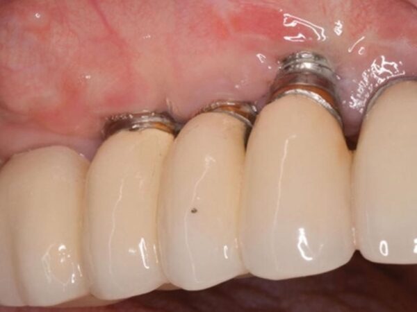 Tác hại của việc trồng răng Implant: Những biến chứng cần biết và cách phòng tránh 3 Vẫn có trường hợp cơ thể bệnh nhân đào thải trụ cấy ghép