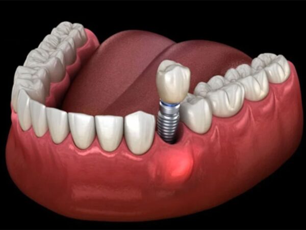 Tác hại của việc trồng răng Implant: Những biến chứng cần biết và cách phòng tránh 4 Vẫn có một tỷ lệ nhỏ bệnh nhân nhạy cảm với Implant