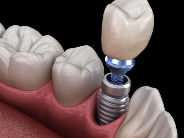 Tác hại của việc trồng răng Implant: Những biến chứng cần biết và cách phòng tránh 5 Chất lượng của trụ Implant có vai trò quyết định đến khả năng tích hợp với xương