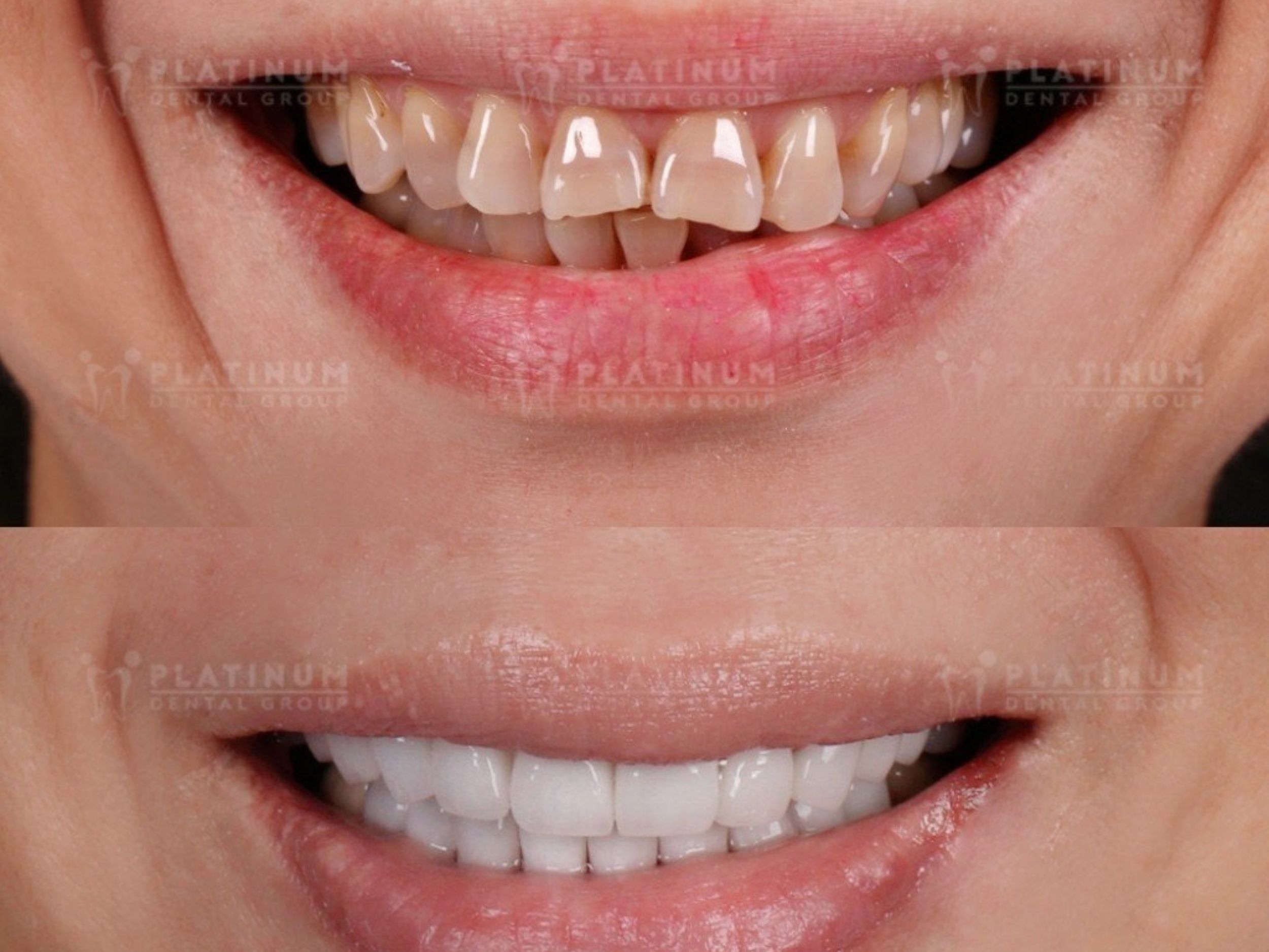 16-Tooth Porcelain Veneer Case - High School Principal Ngoc Hieu