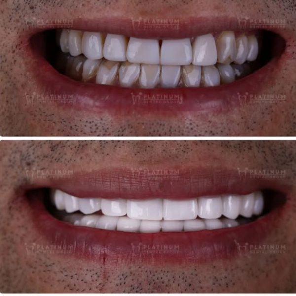 Tetracycline stained Teeth – Symptoms, Causes, and Effective Solutions 8 Mr. Kenny chose full-arch porcelain veneers