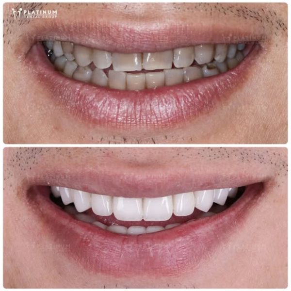 Tetracycline stained Teeth – Symptoms, Causes, and Effective Solutions 9 Mr. Bill Huynh and Smile Transformation Journey