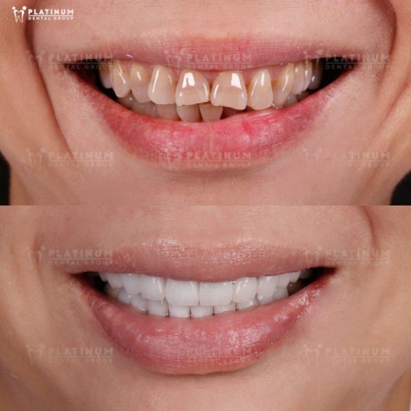 Tetracycline stained Teeth – Symptoms, Causes, and Effective Solutions 10 16-Tooth Porcelain Veneer Case - High School Principal Ngoc Hieu