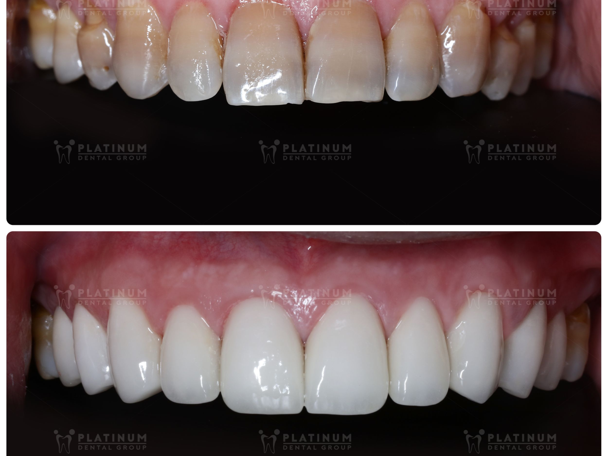 Teeth whitening is commonly used for mild cases of tetracycline stained teeth