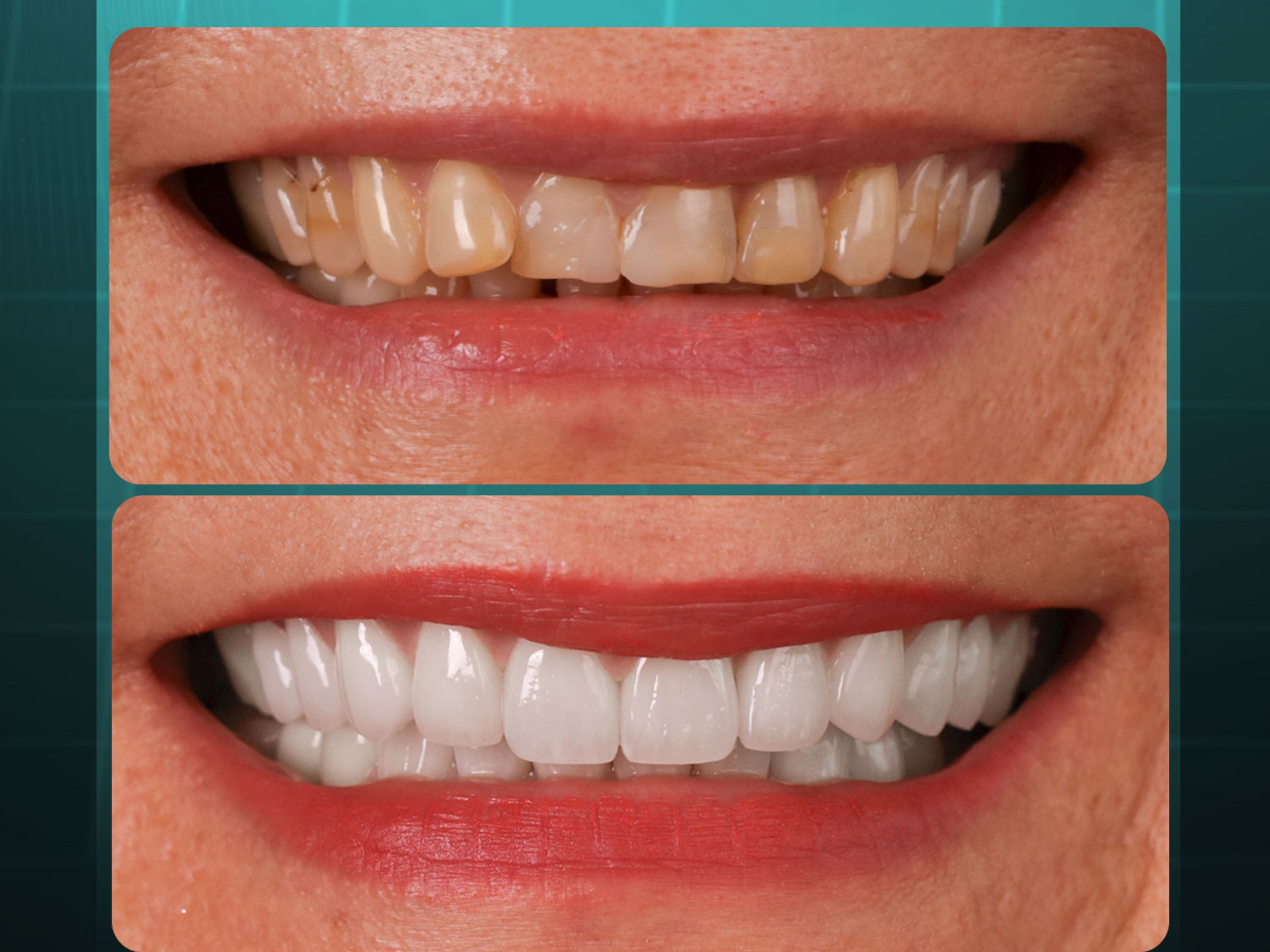 Choose porcelain crowns to improve tooth color, restore shape, and enhance chewing function