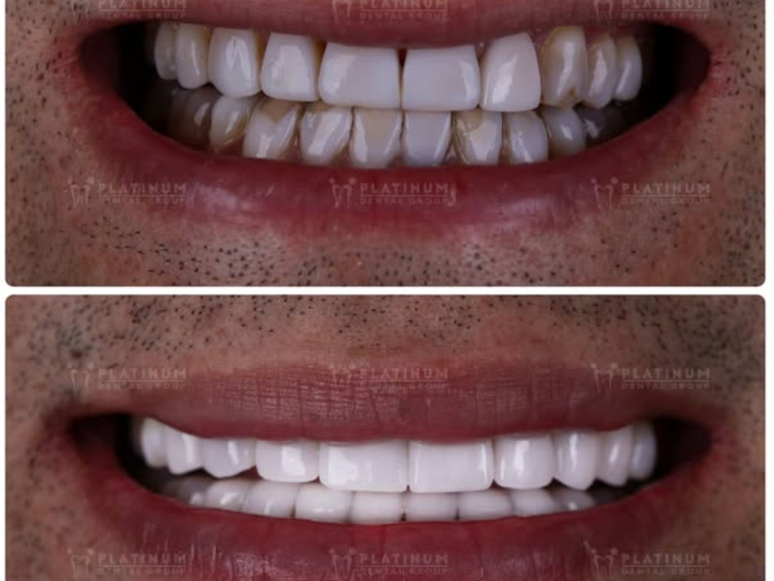 Mr. Kenny chose full-arch porcelain veneers