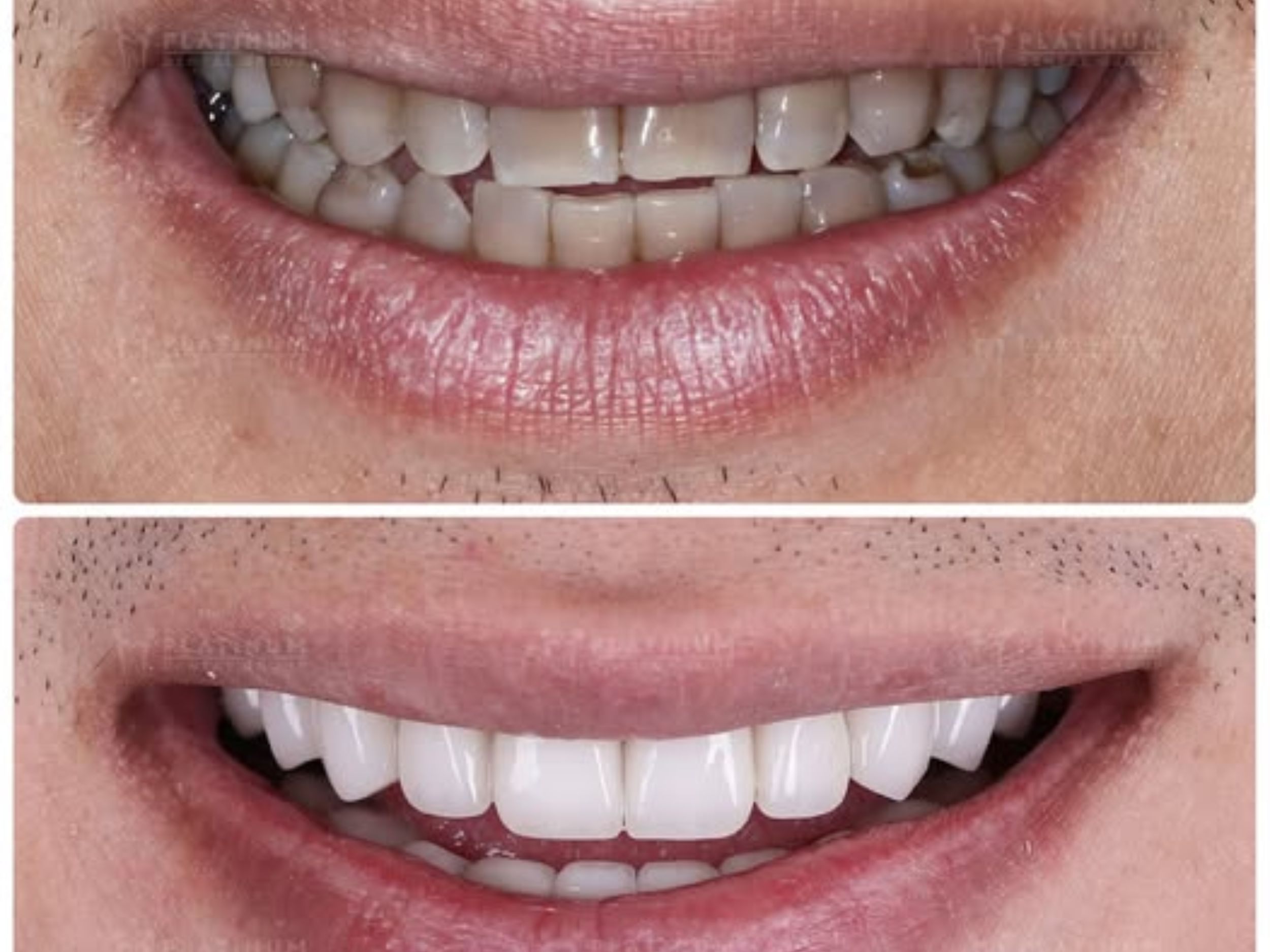 Mr. Bill Huynh and Smile Transformation Journey 