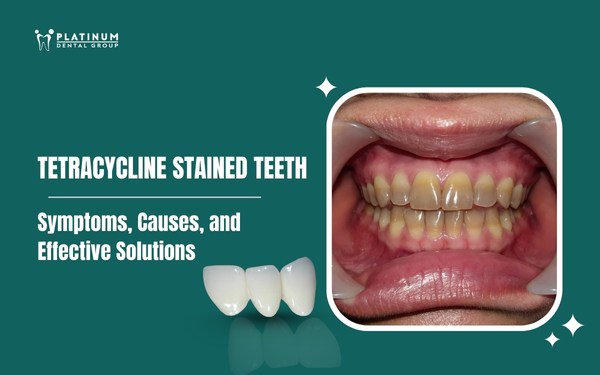 tetracycline stained teeth