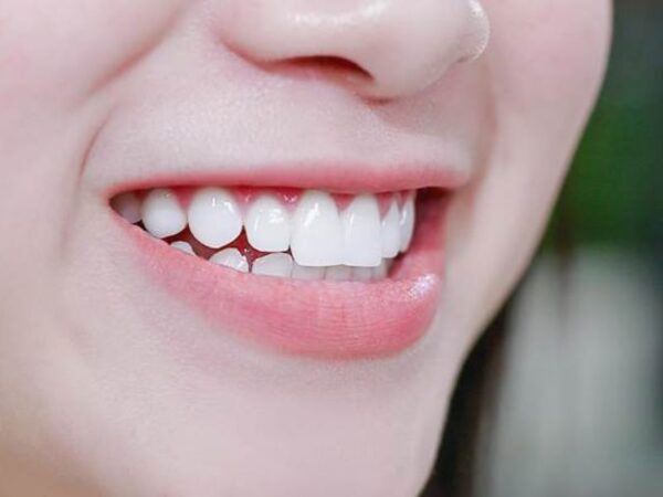 Chi phí trồng răng sứ phụ thuộc vào nhiều yếu tố như phương pháp, vật liệu và tình trạng răng miệng thực tế