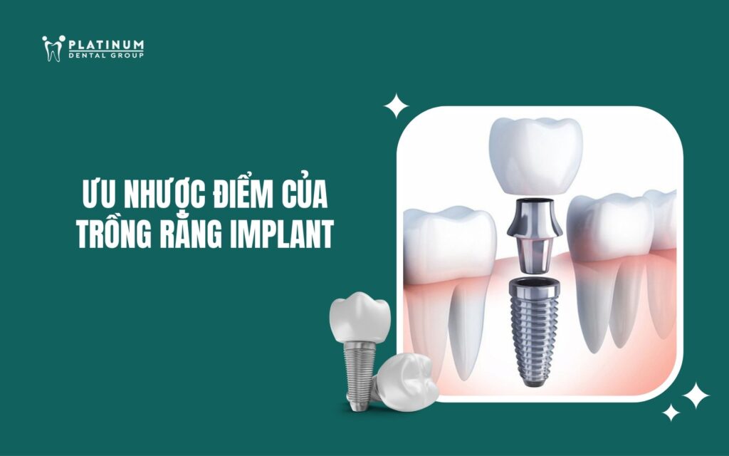 ưu nhược điểm của trồng răng implant