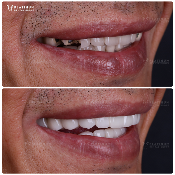 Mão sứ bao phủ toàn bộ thân răng, răng thật bên trong được bảo vệ tốt hơn